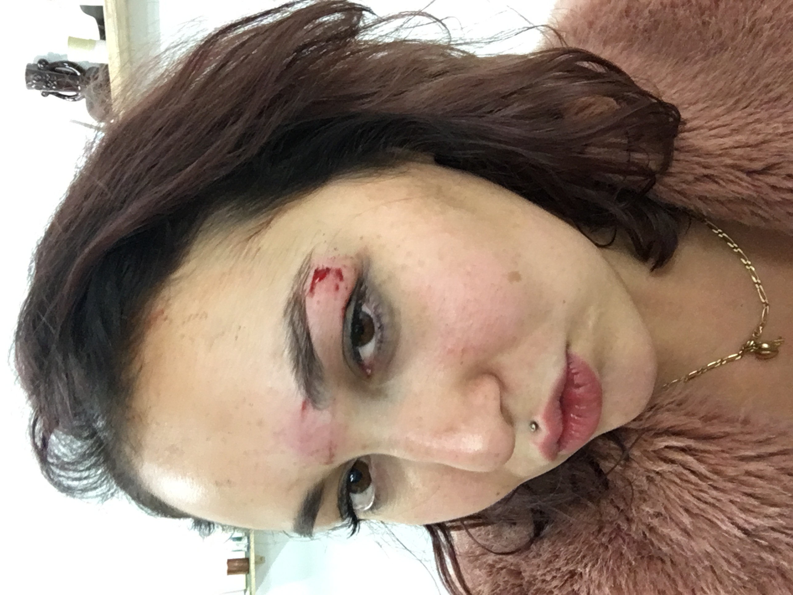 Photo de Clélia qui a l'arcade ouverte après que l'enseigne lui soit tombée dessus. On voit clairement l'épaisseur de la tranche sur son arcade et son front.