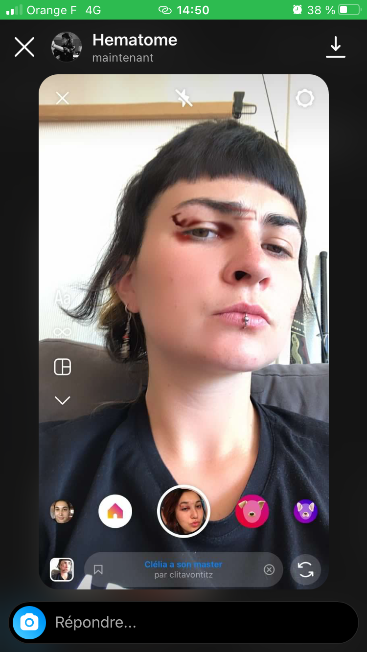 Une jeune femme se prends en selfie et on voit une blessure de la forme d'une barre avec un angle tres prononcé au-dessus de son arcade, un oeil au beurre noir s'est formé au dessous.