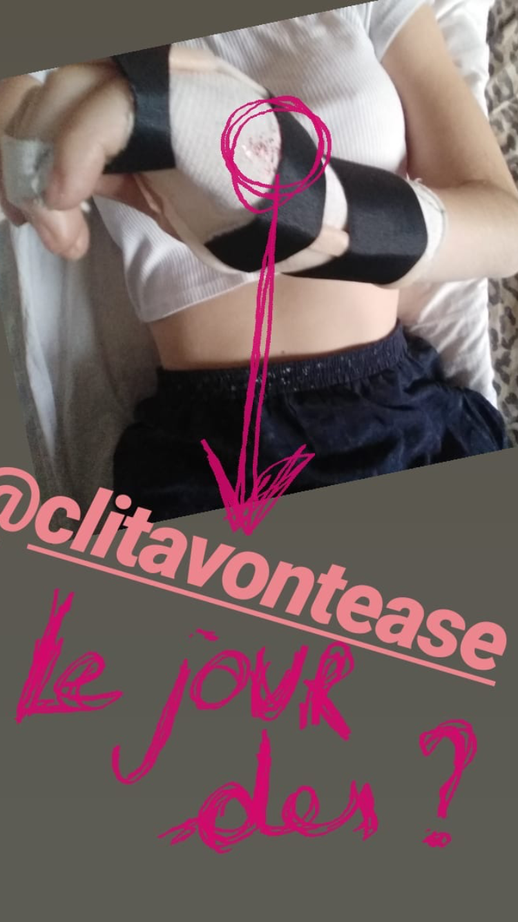 Capture d'écran d'instagram, on voit quelq'un avec une atelle qui est recouvertes de paillettes rouges sur un côté. Au dessous la mention @clitavontease le jour des ?.